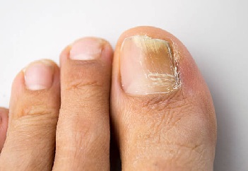 fungal nail